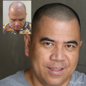 Norwood 7 New Hairline, Top of Scalp, Crown & Lower Crown.
