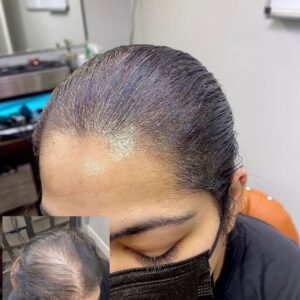 Women’s Density without Shaven Hair